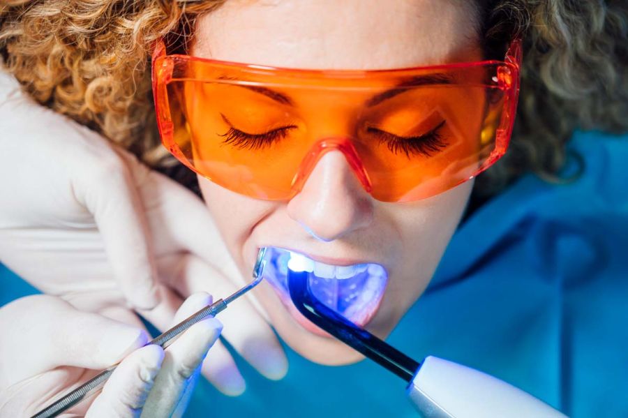 blanqueamiento dental sant cugat