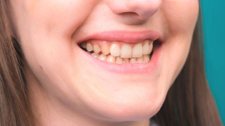 Fluorosis Dental