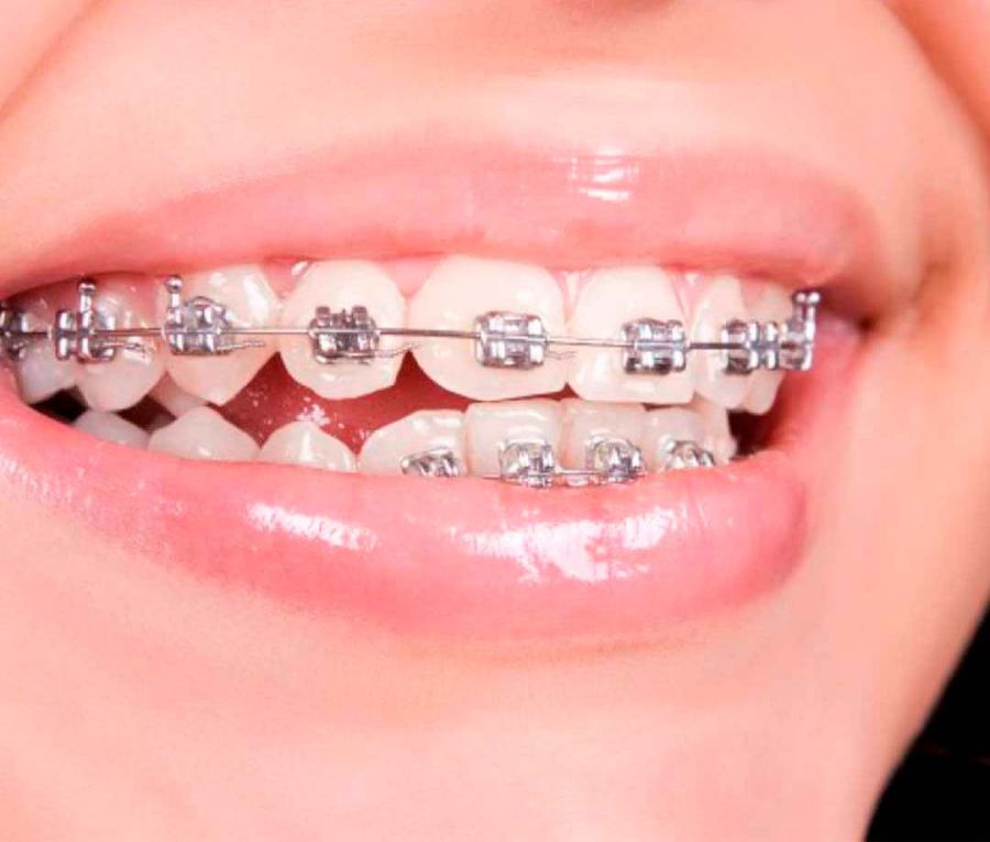 Brackets
