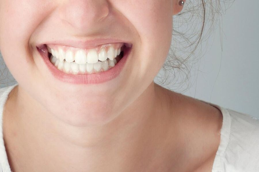 Fluorosis Dental