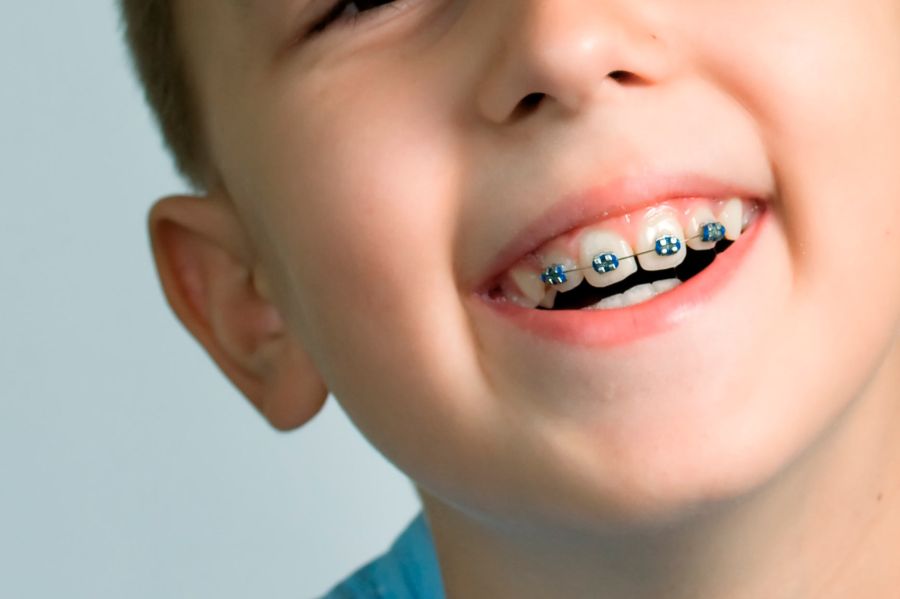 ortodoncia BRACKETS